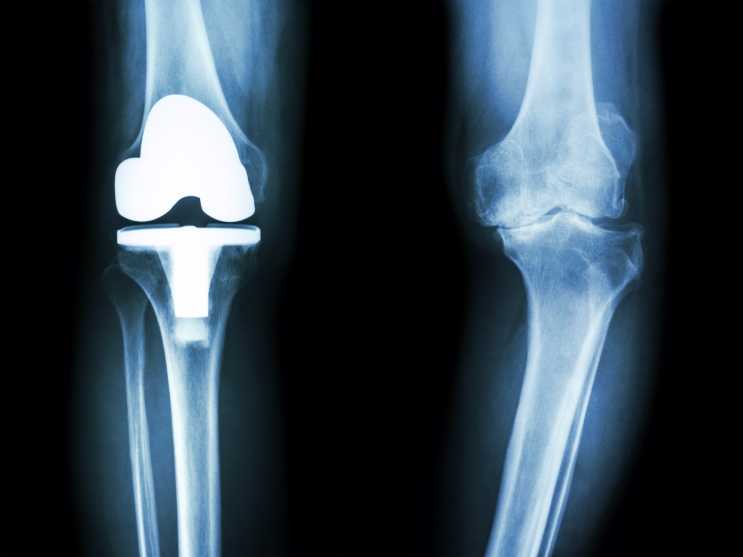 Prosthetic knee to be measured optically