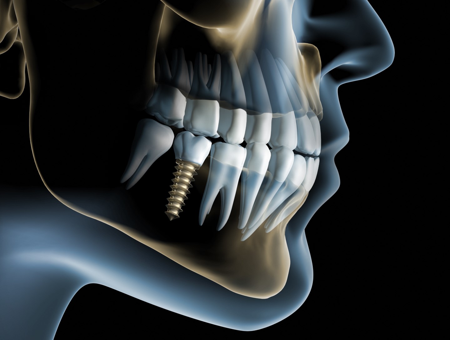 tooth implants to be measured with optical metrology