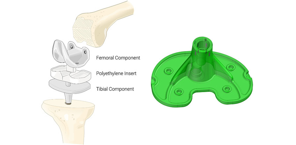 Mesure 3D d'un implant de genou