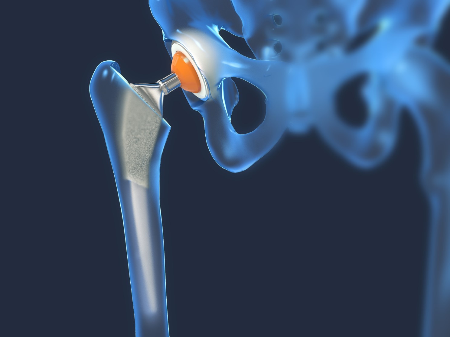 hip prosthetic only with optical 3D metrology